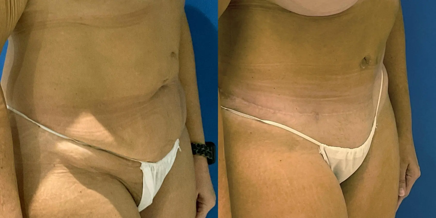 Tummy Tuck: Patient 8 - Before and After 3