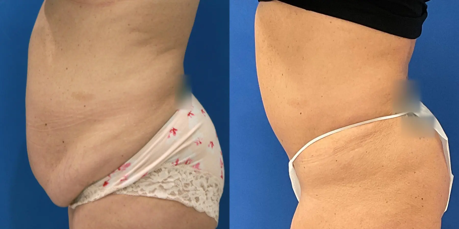 Tummy Tuck: Patient 14 - Before and After 2