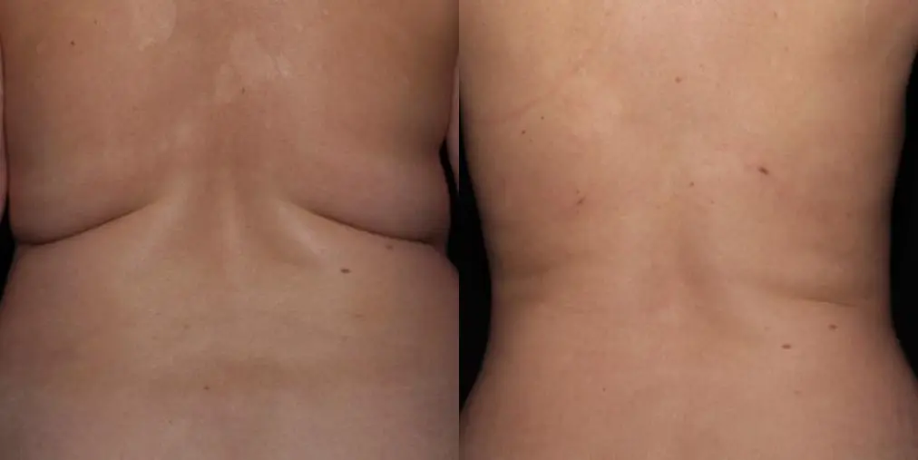 BodyTite: Patient 8 - Before and After  