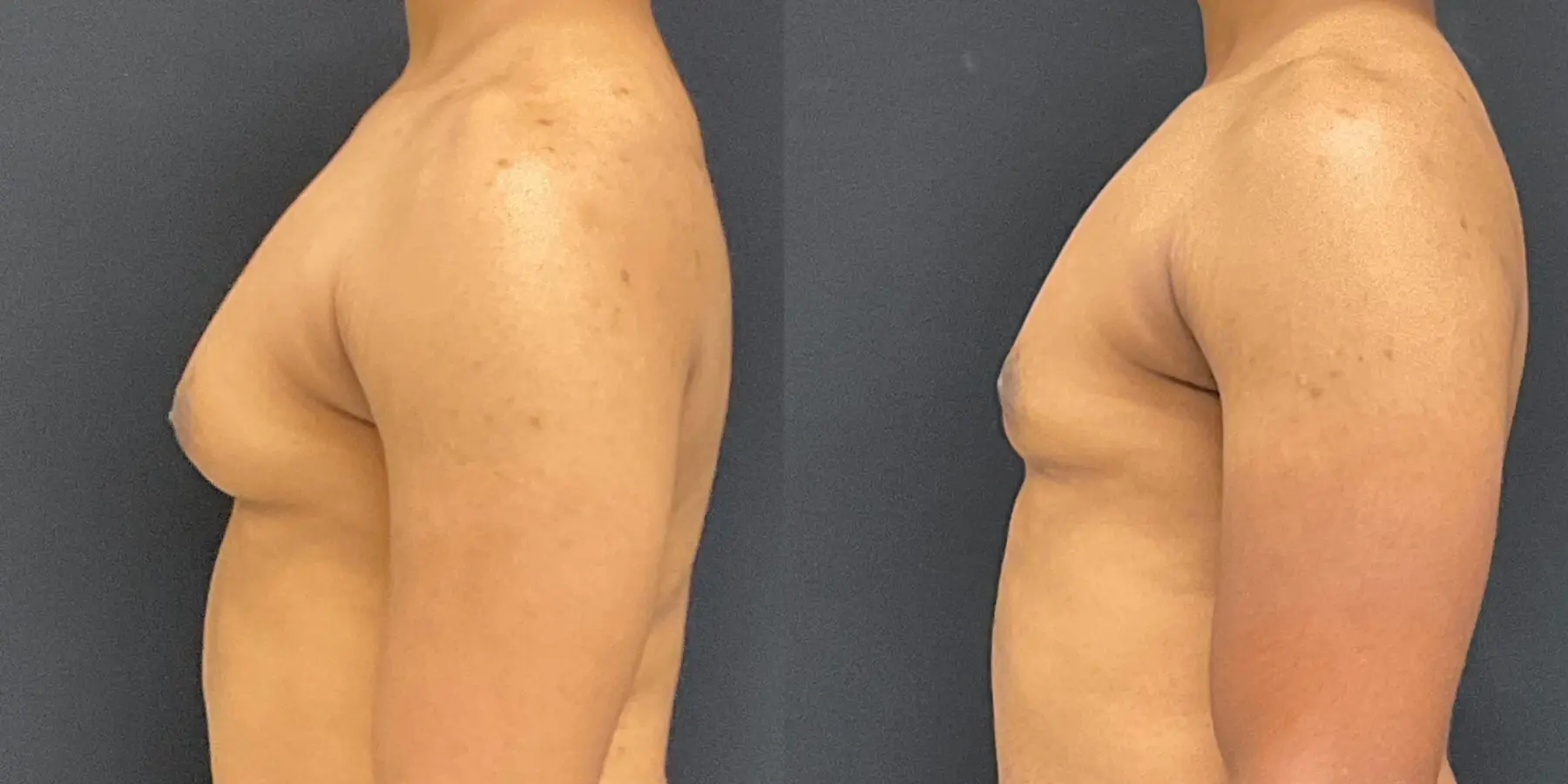 Bodytite For Men: Patient 1 - Before and After 4