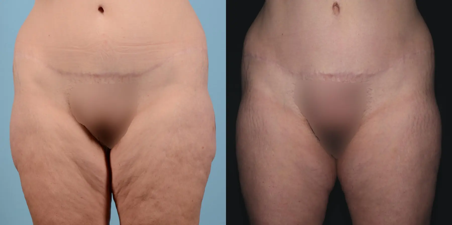 BodyTite: Patient 5 - Before and After  