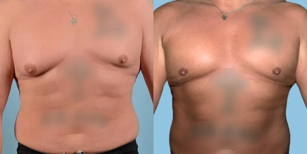 Bodytite-for-men: Patient 4 - Before and After  