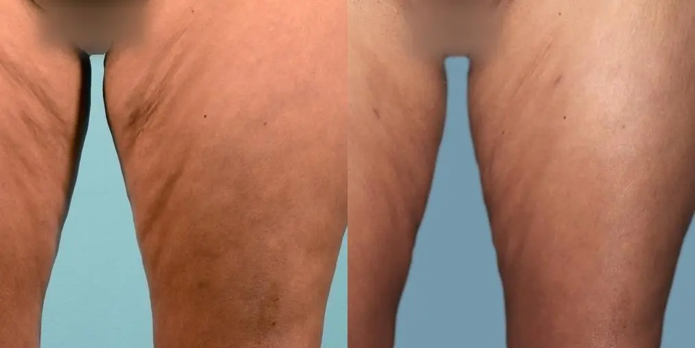 BodyTite: Patient 1 - Before and After 1