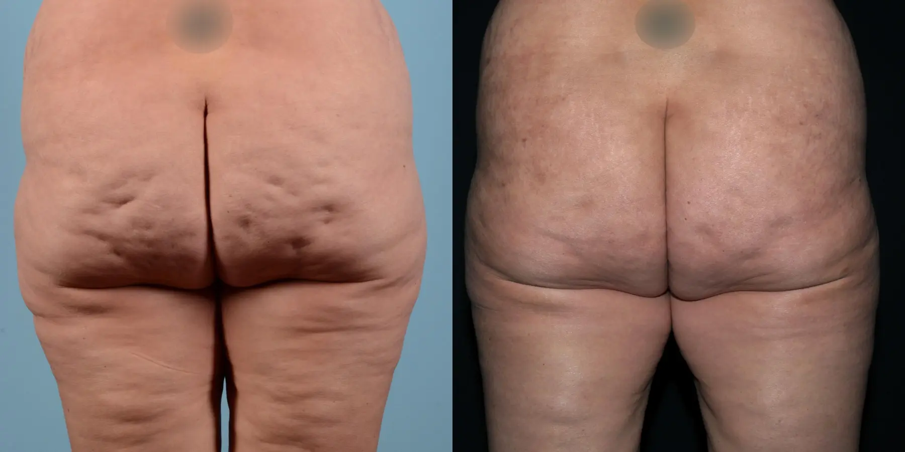 BodyTite: Patient 5 - Before and After 5