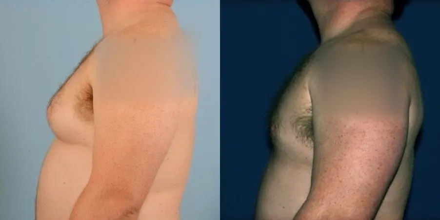 Bodytite For Men: Patient 3 - Before and After 1