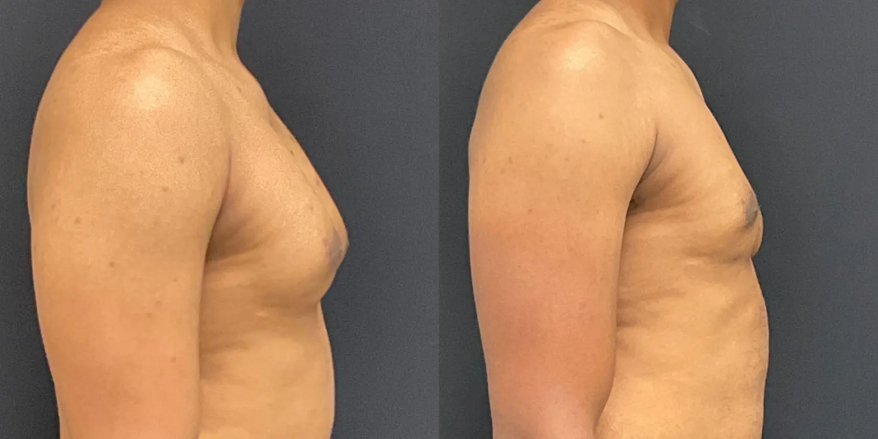 Bodytite For Men: Patient 1 - Before and After 5