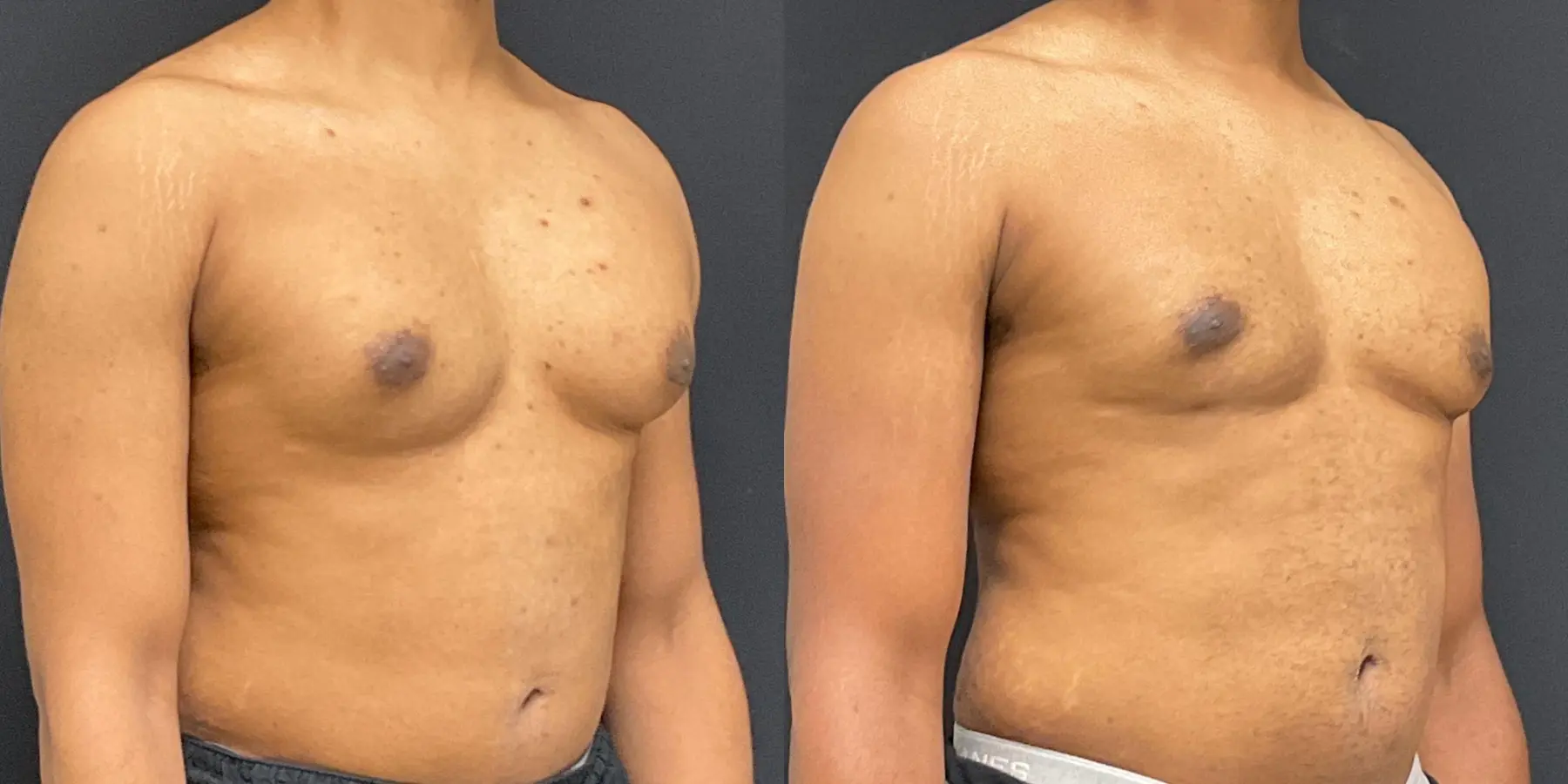 Bodytite For Men: Patient 1 - Before and After 3