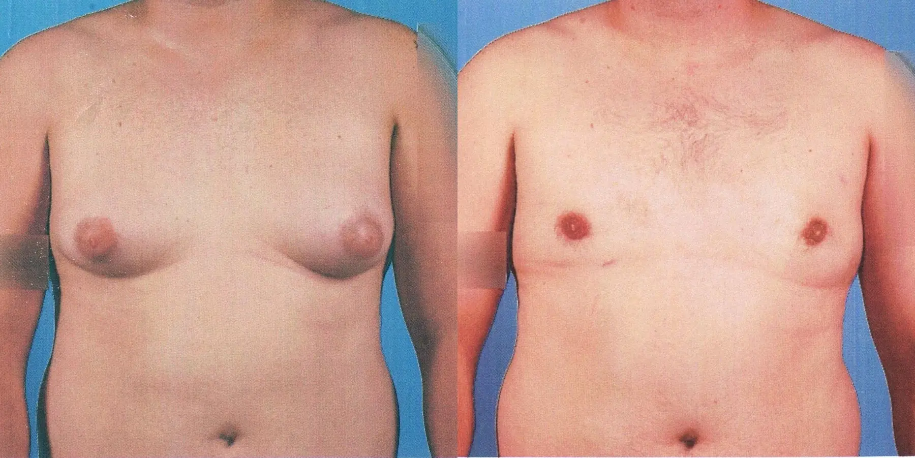 Bodytite For Men: Patient 2 - Before and After 1