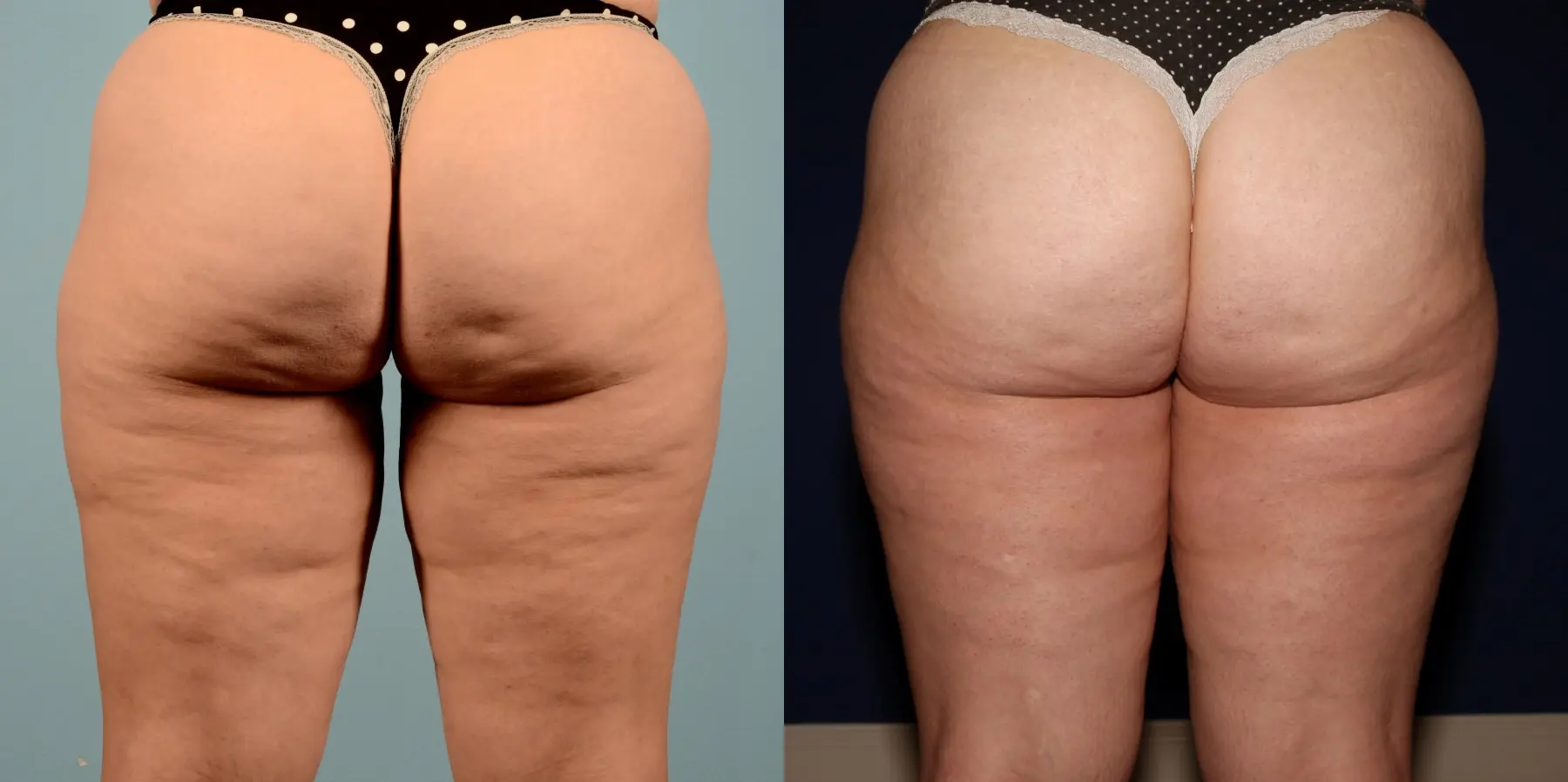 BodyTite: Patient 7 - Before and After  