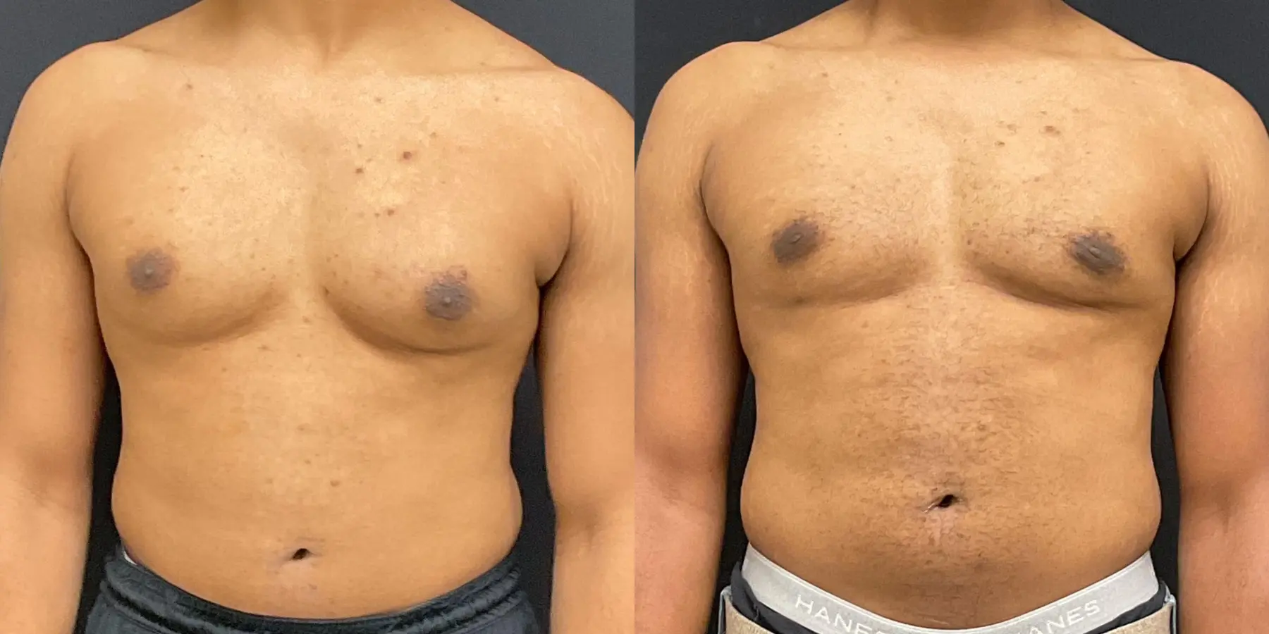 Bodytite-for-men: Patient 1 - Before and After  