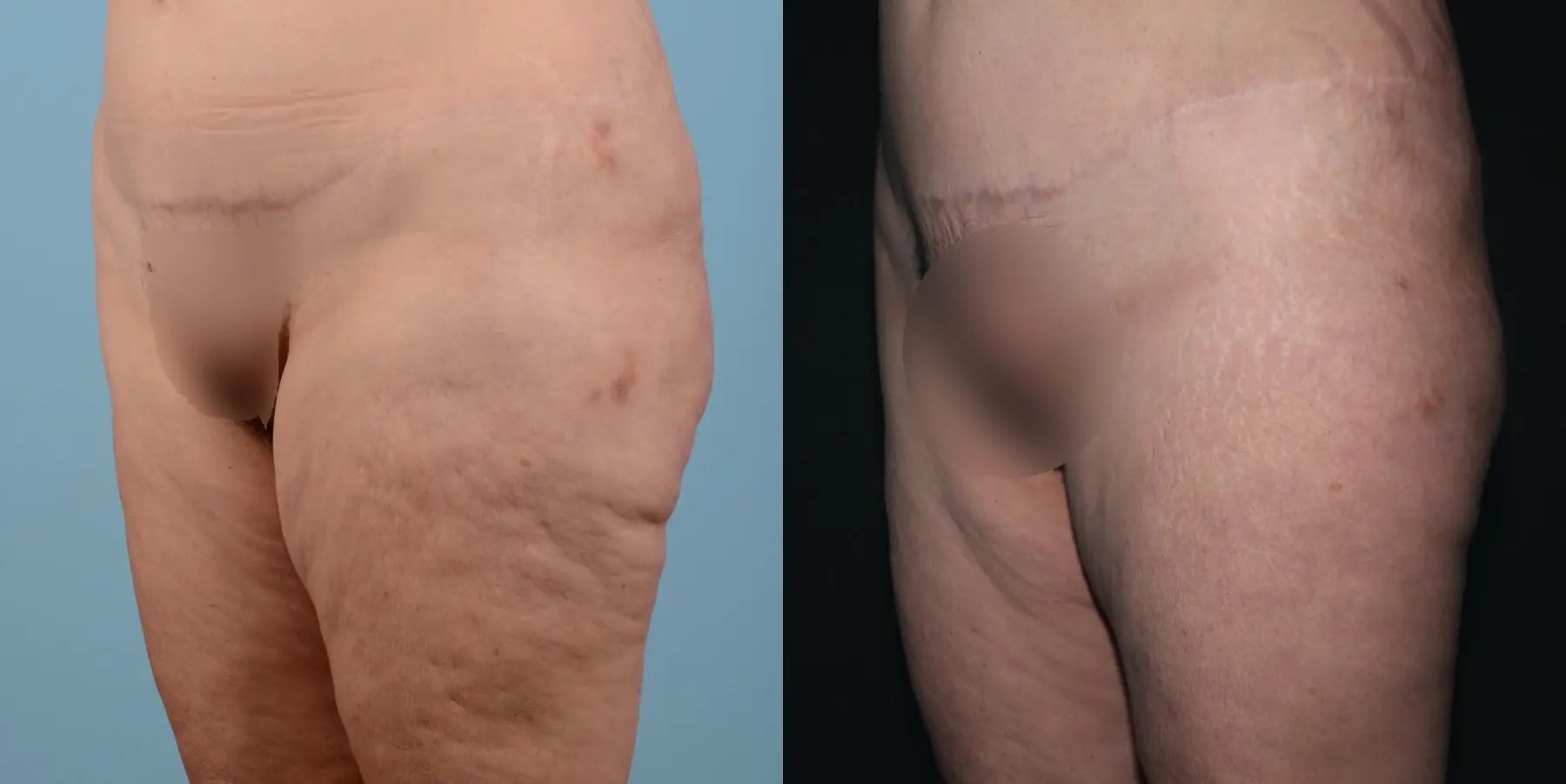 BodyTite: Patient 5 - Before and After 2