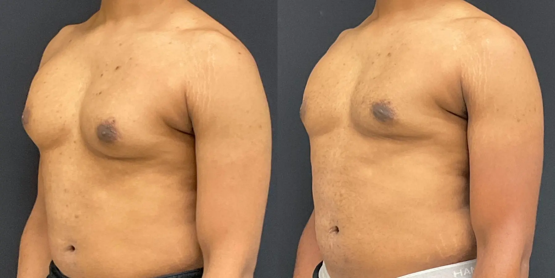 Bodytite For Men: Patient 1 - Before and After 2