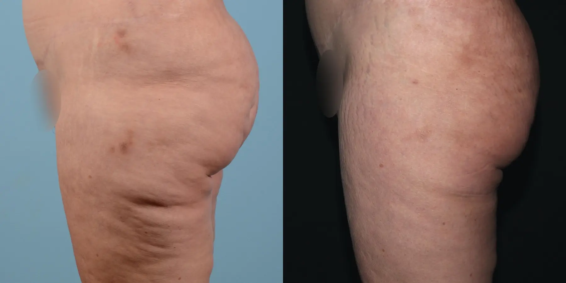 BodyTite: Patient 5 - Before and After 3