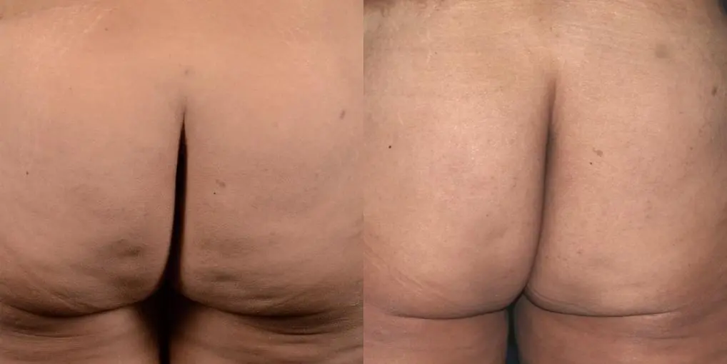 BodyTite: Patient 1 - Before and After 2