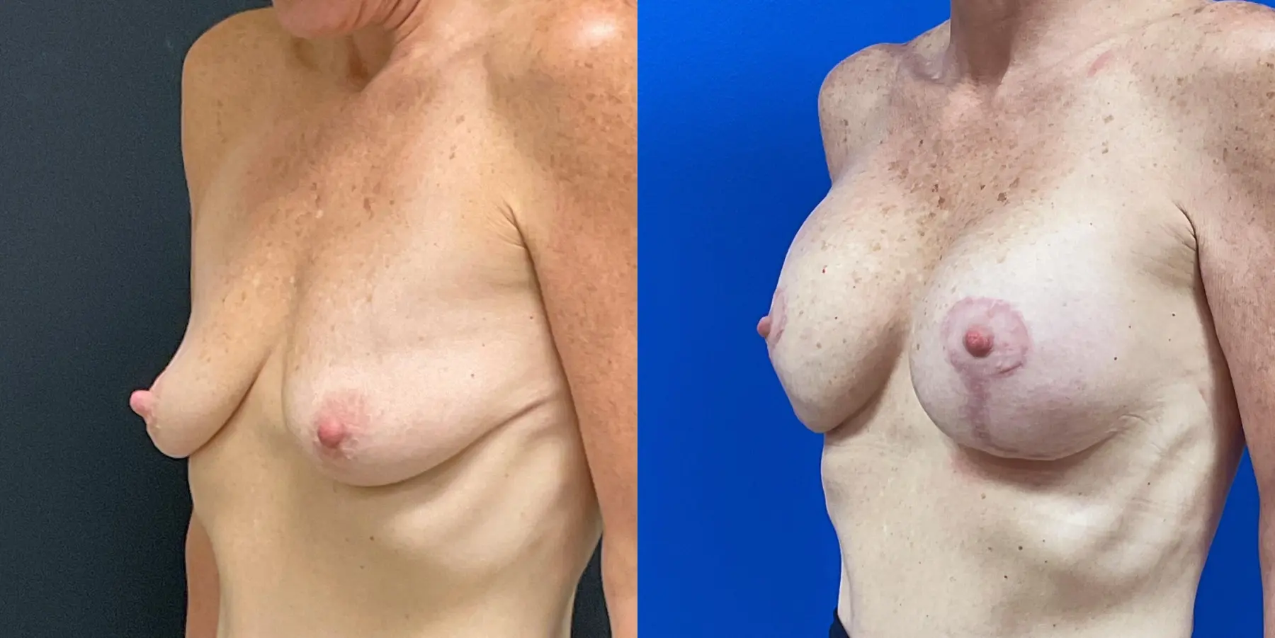 Breast Augmentation: Patient 9 - Before and After 2