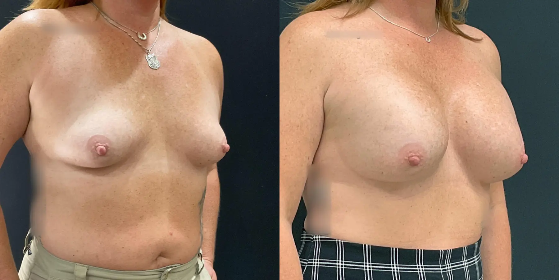 Breast Augmentation: Patient 4 - Before and After 3