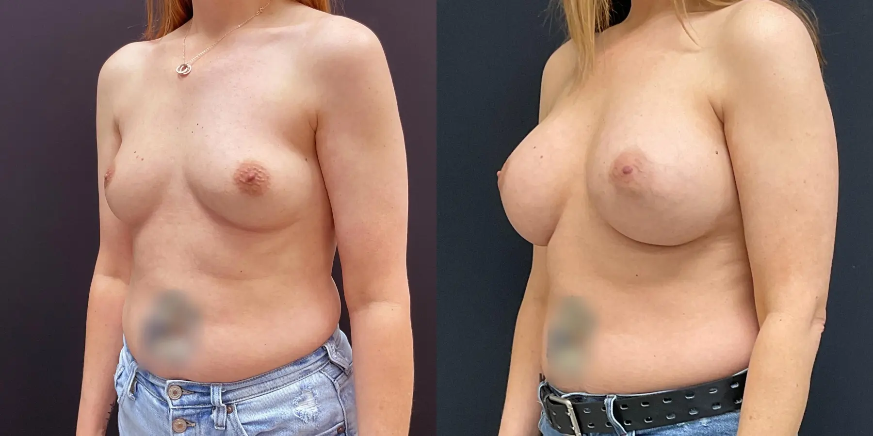 Breast Augmentation: Patient 5 - Before and After 2