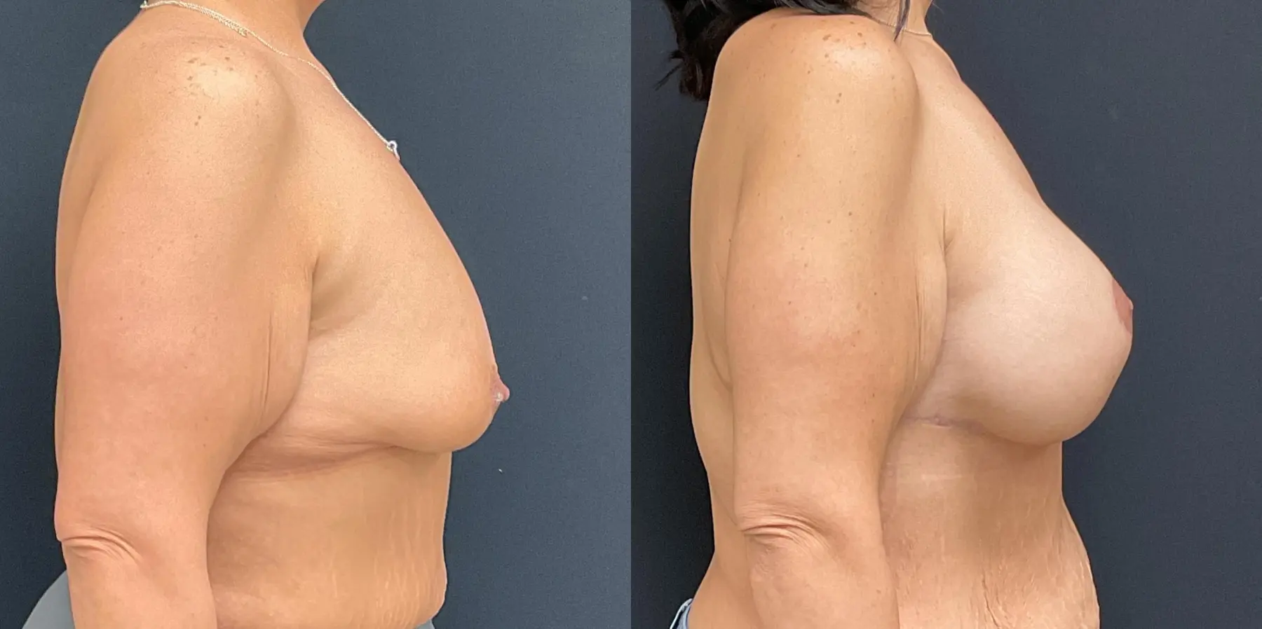 Breast Augmentation: Patient 10 - Before and After 5