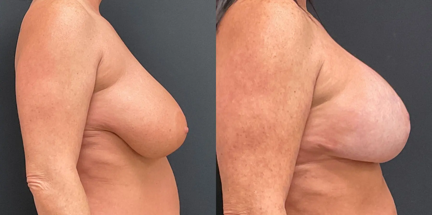 Breast Augmentation: Patient 6 - Before and After 5