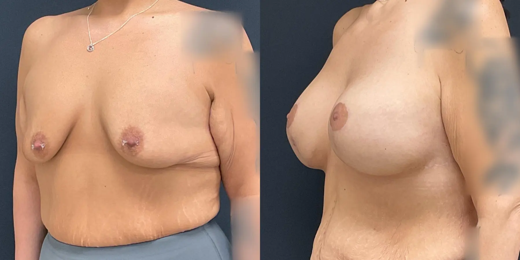 Breast Augmentation: Patient 12 - Before and After 2