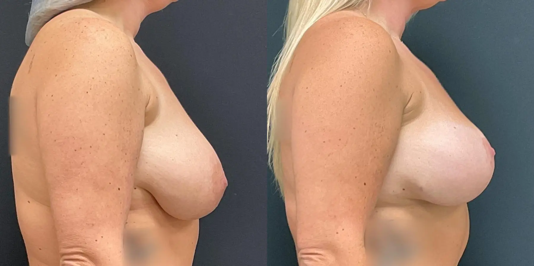 Breast Augmentation: Patient 11 - Before and After 5