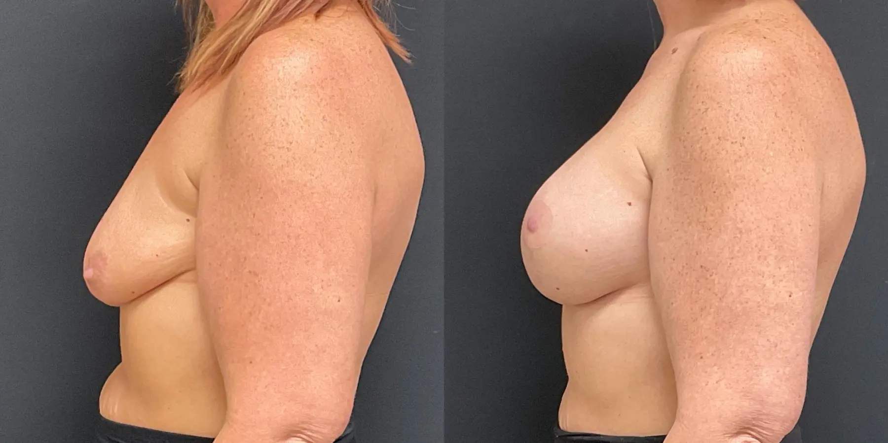 Breast Augmentation: Patient 11 - Before and After 4