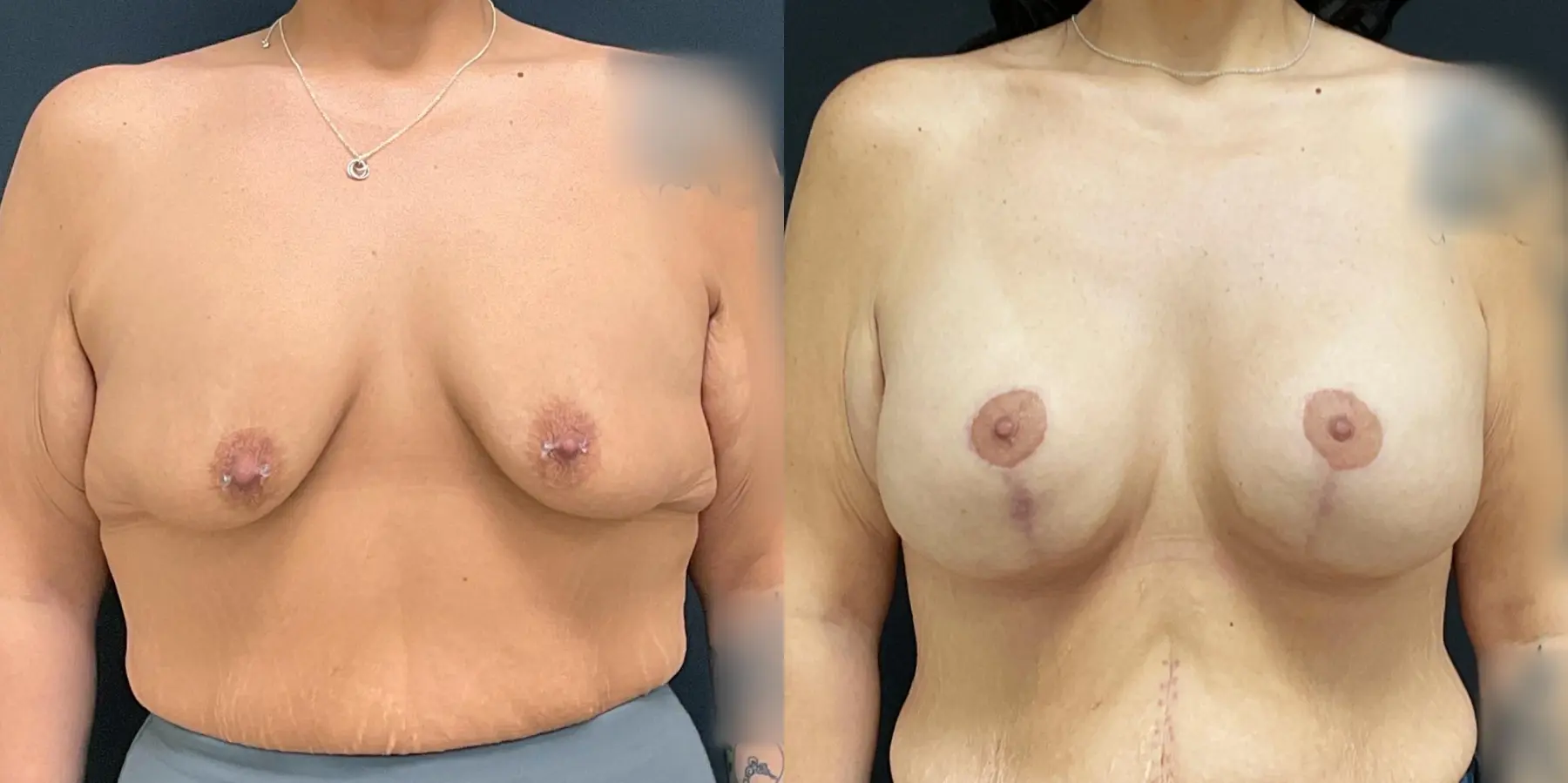 Breast Augmentation: Patient 10 - Before and After 1