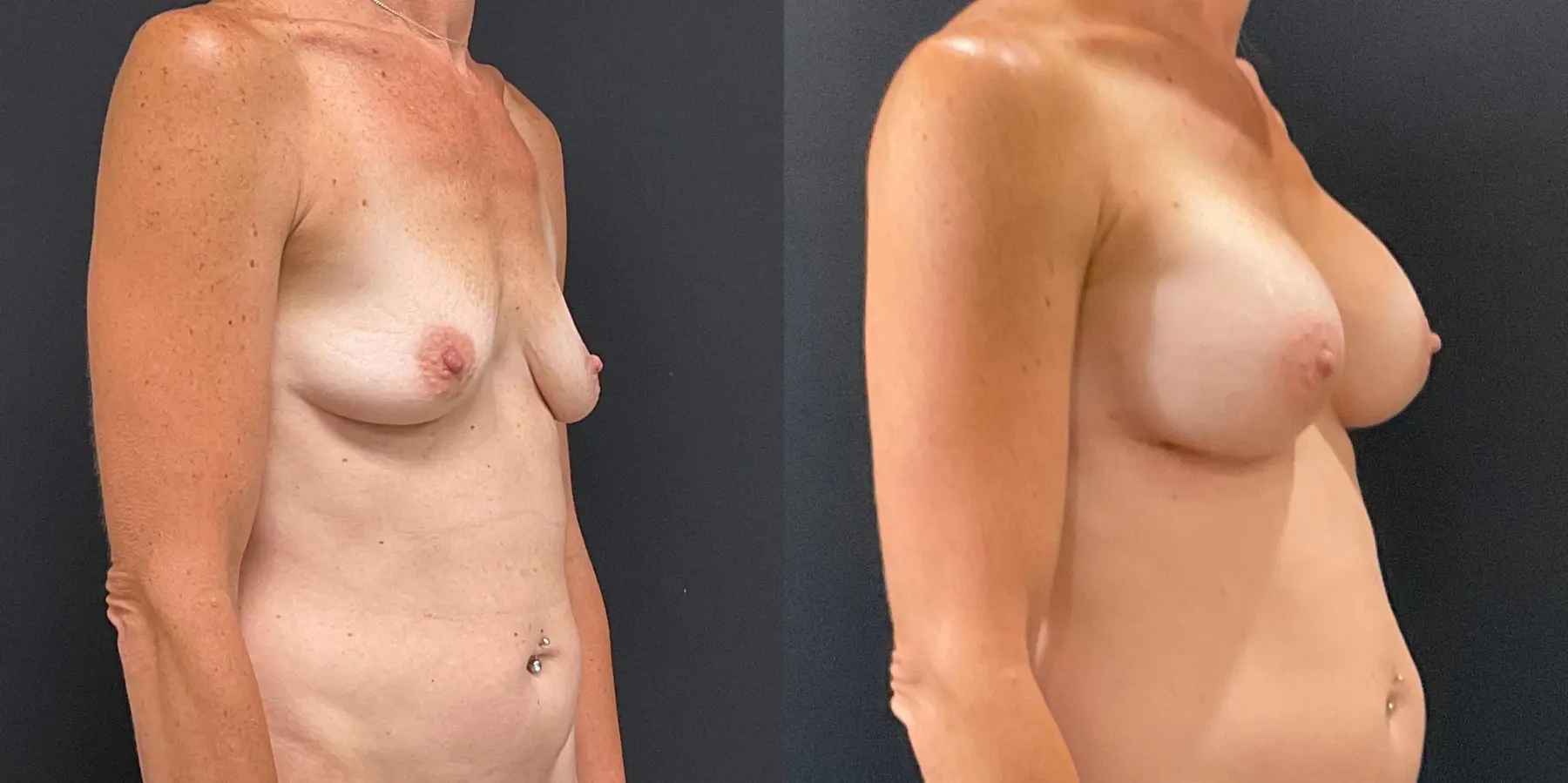 Breast Augmentation: Patient 5 - Before and After 3