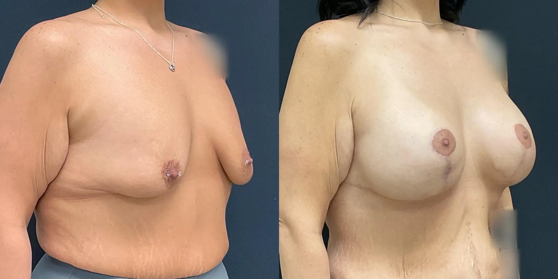 Breast Augmentation: Patient 10 - Before and After 3