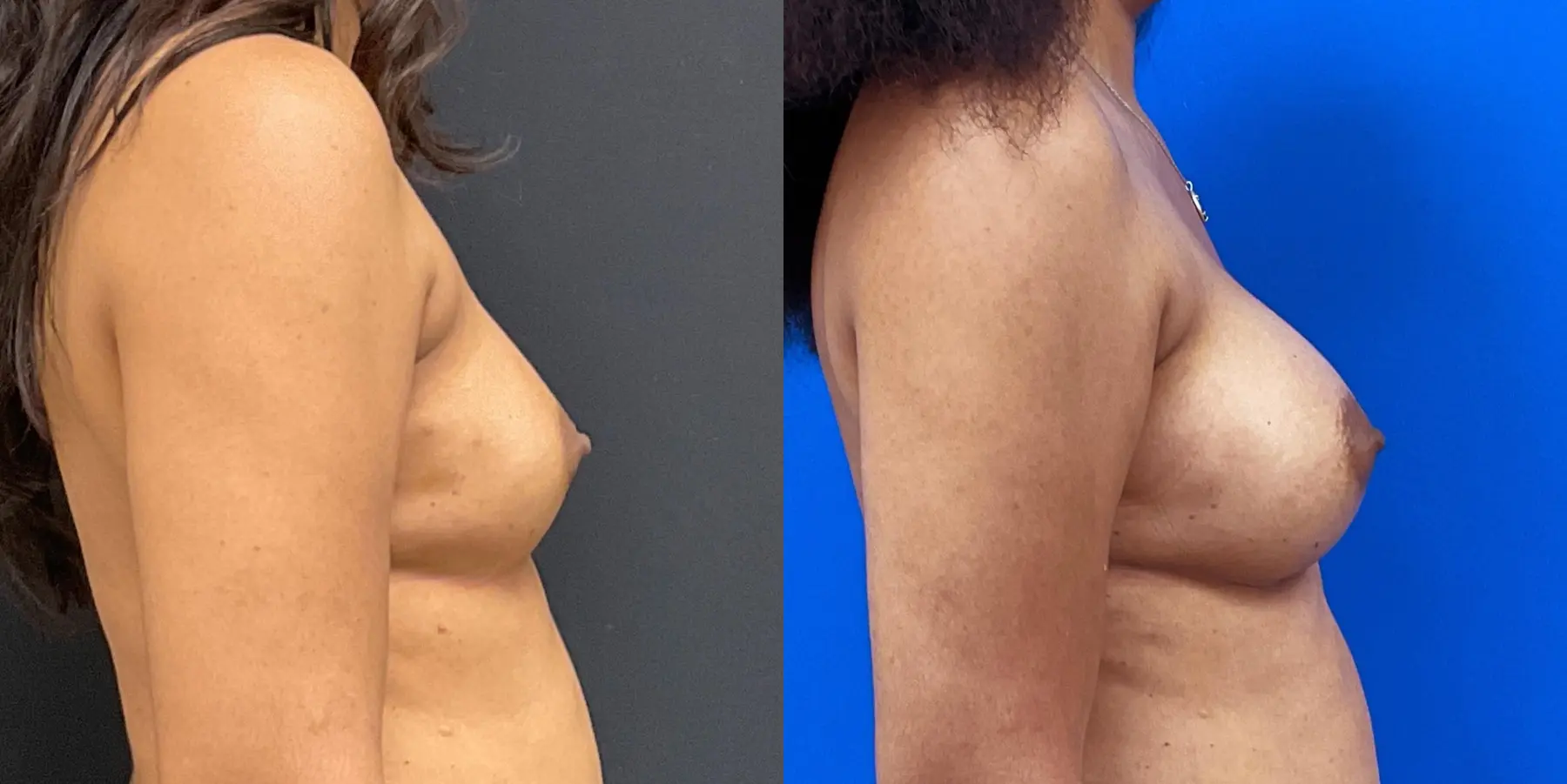 Breast Augmentation: Patient 2 - Before and After 5