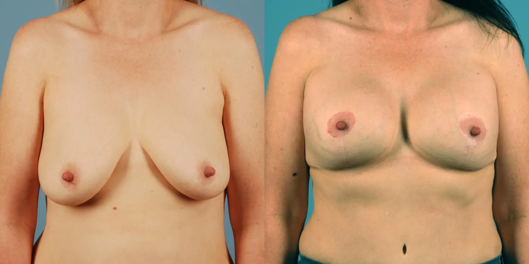 Breast Augmentation: Patient 8 - Before and After  