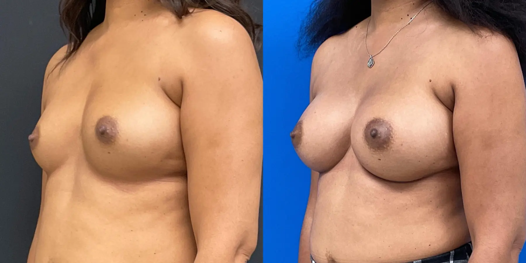 Breast Augmentation: Patient 1 - Before and After 2