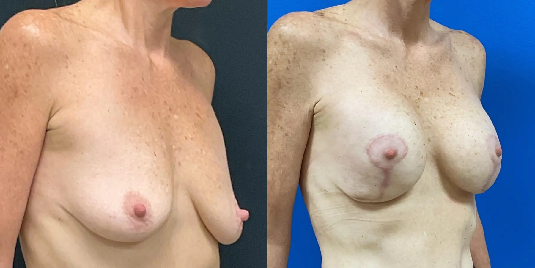 Breast Augmentation: Patient 9 - Before and After 3