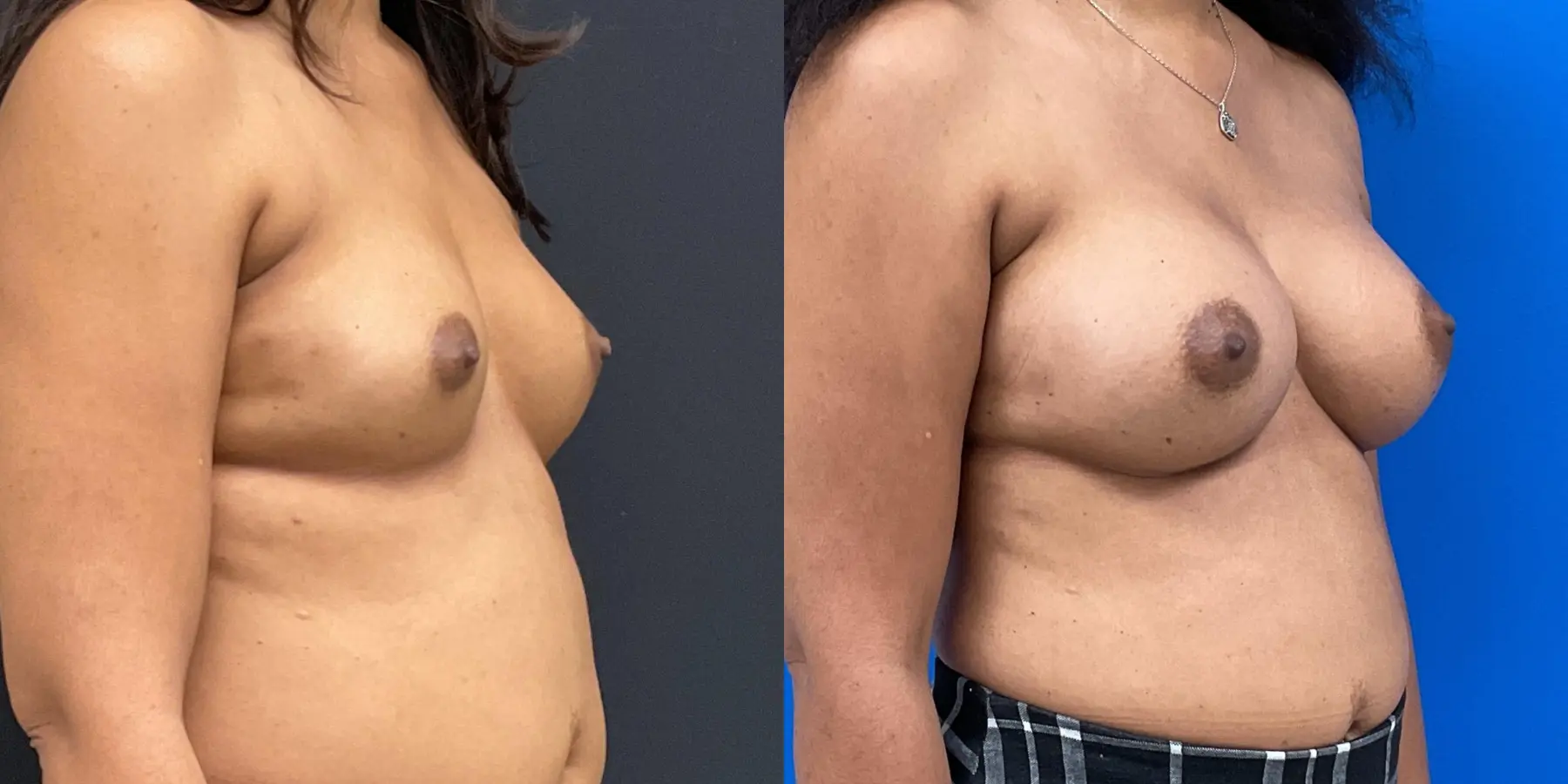 Breast Augmentation: Patient 2 - Before and After 3