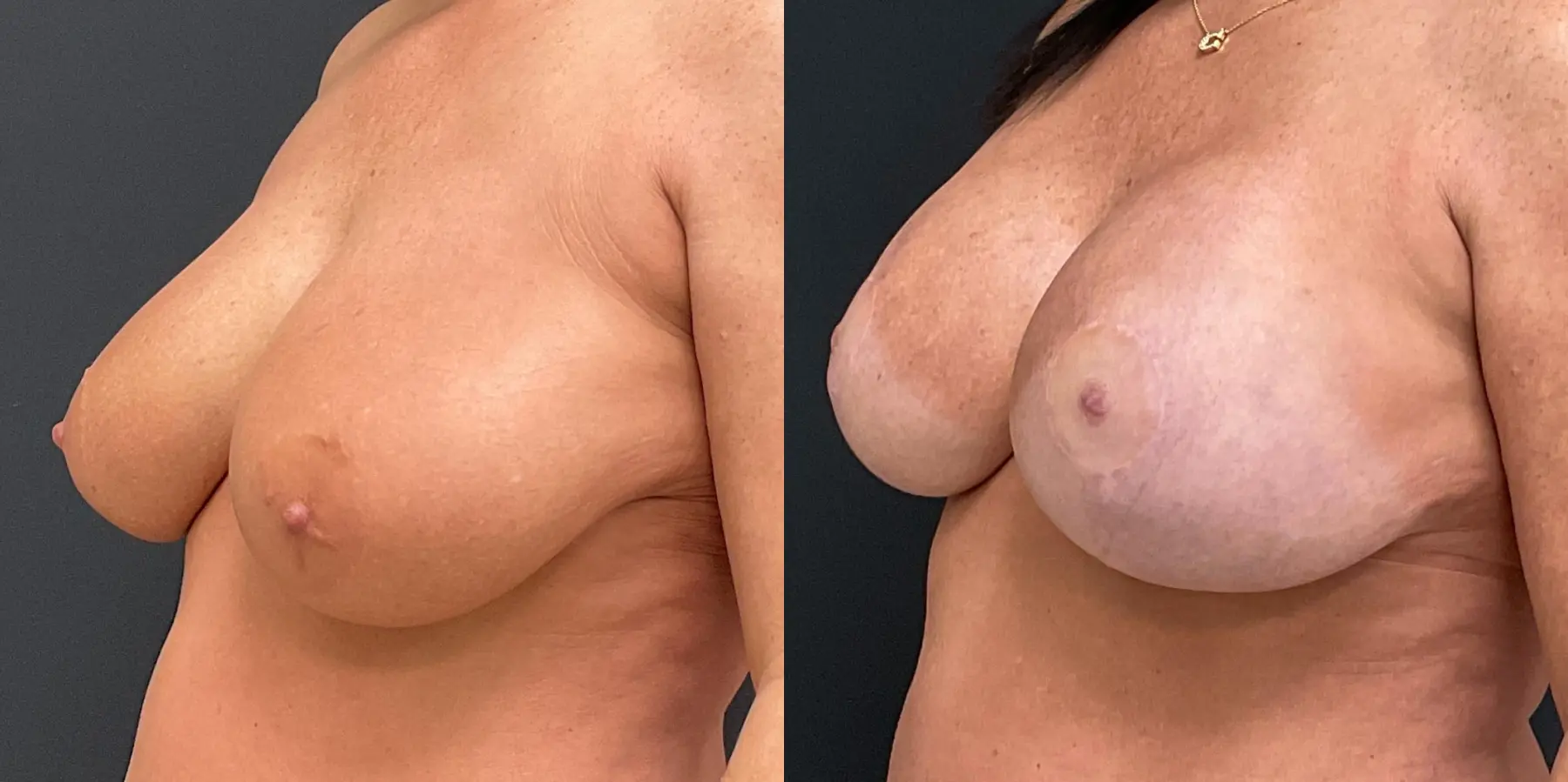 Breast Augmentation: Patient 6 - Before and After 2