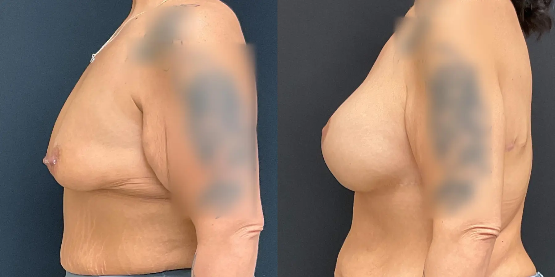 Breast Augmentation: Patient 10 - Before and After 4