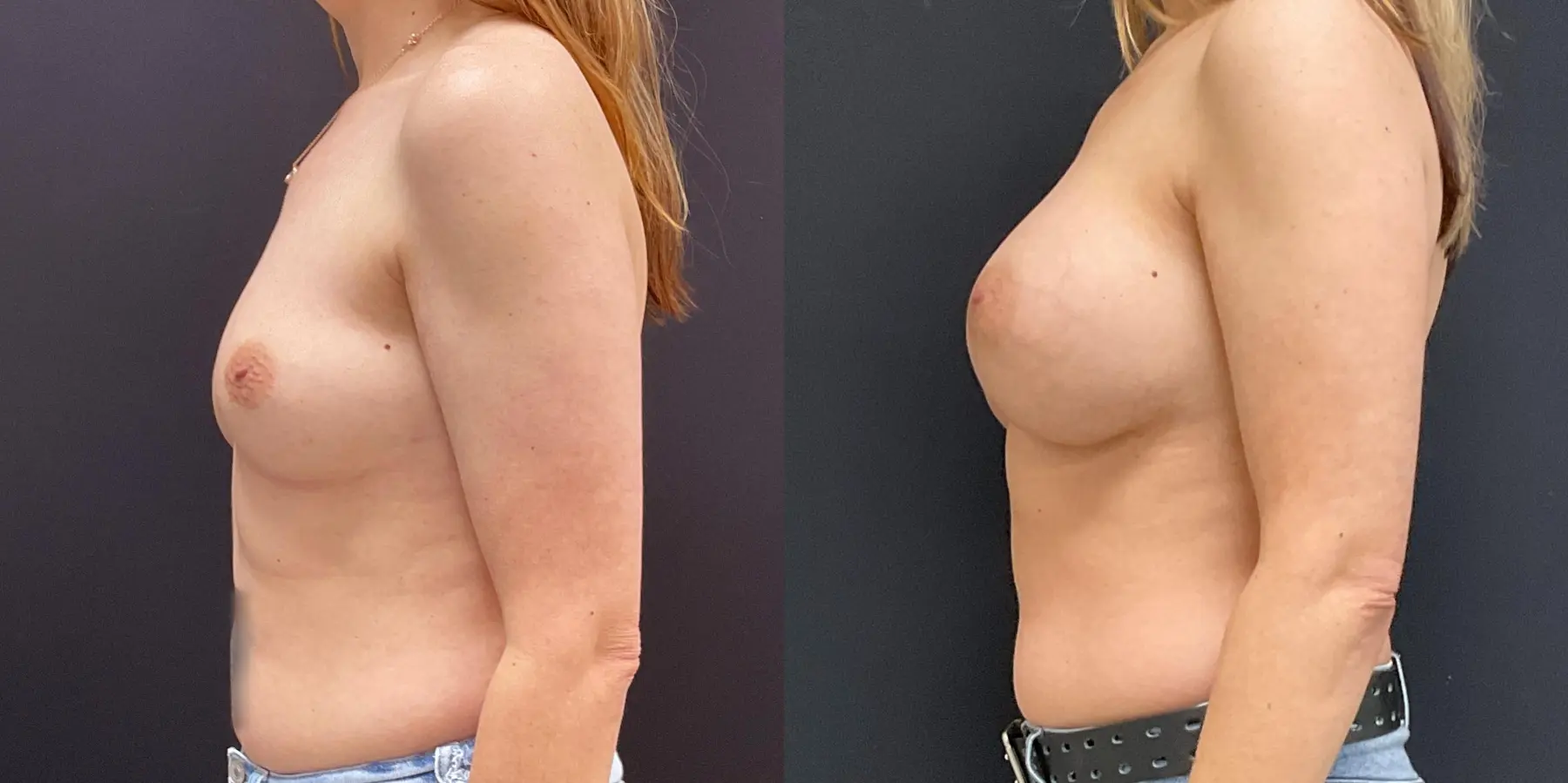 Breast Augmentation: Patient 3 - Before and After 4