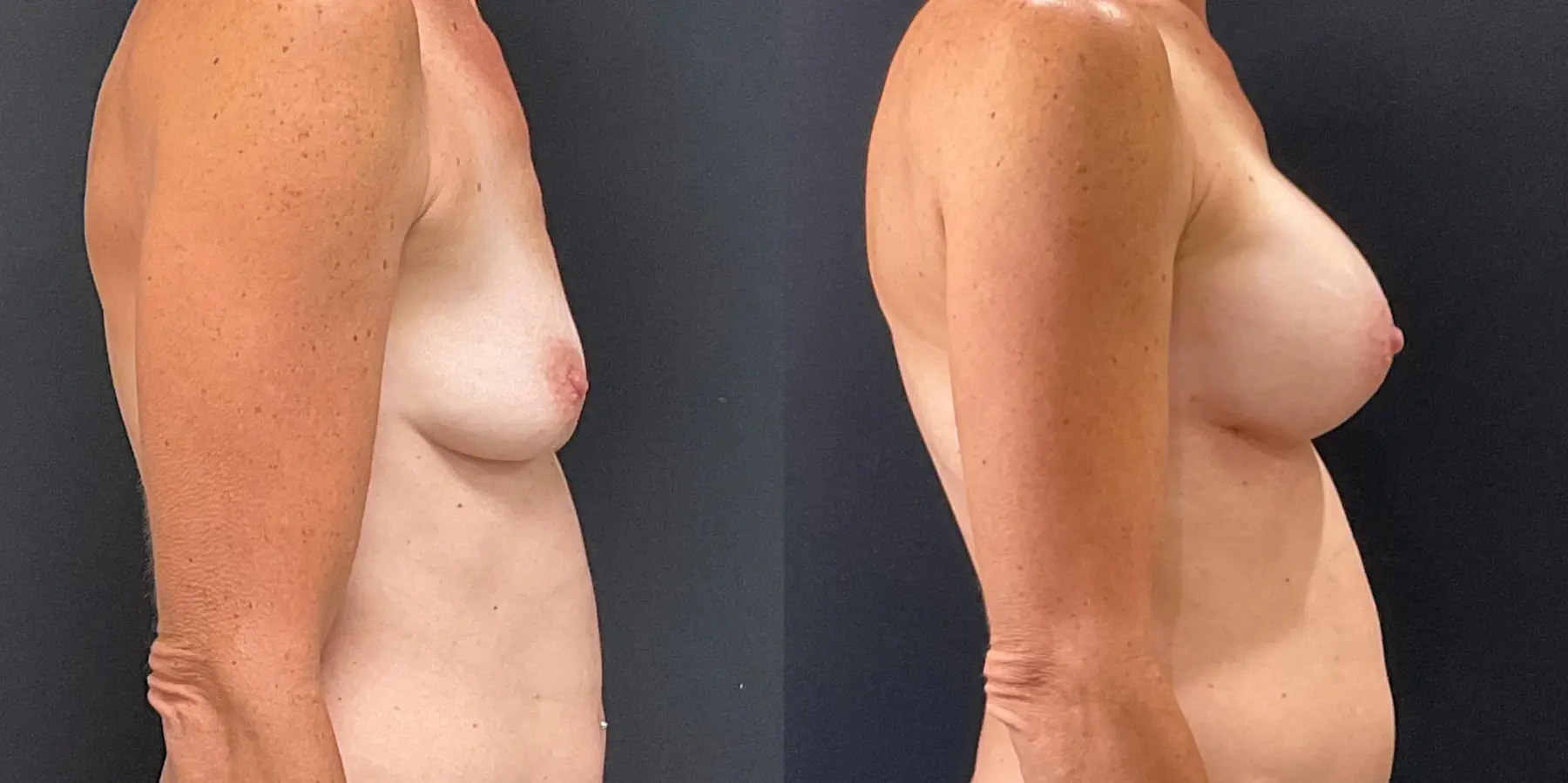 Breast Augmentation: Patient 7 - Before and After 5