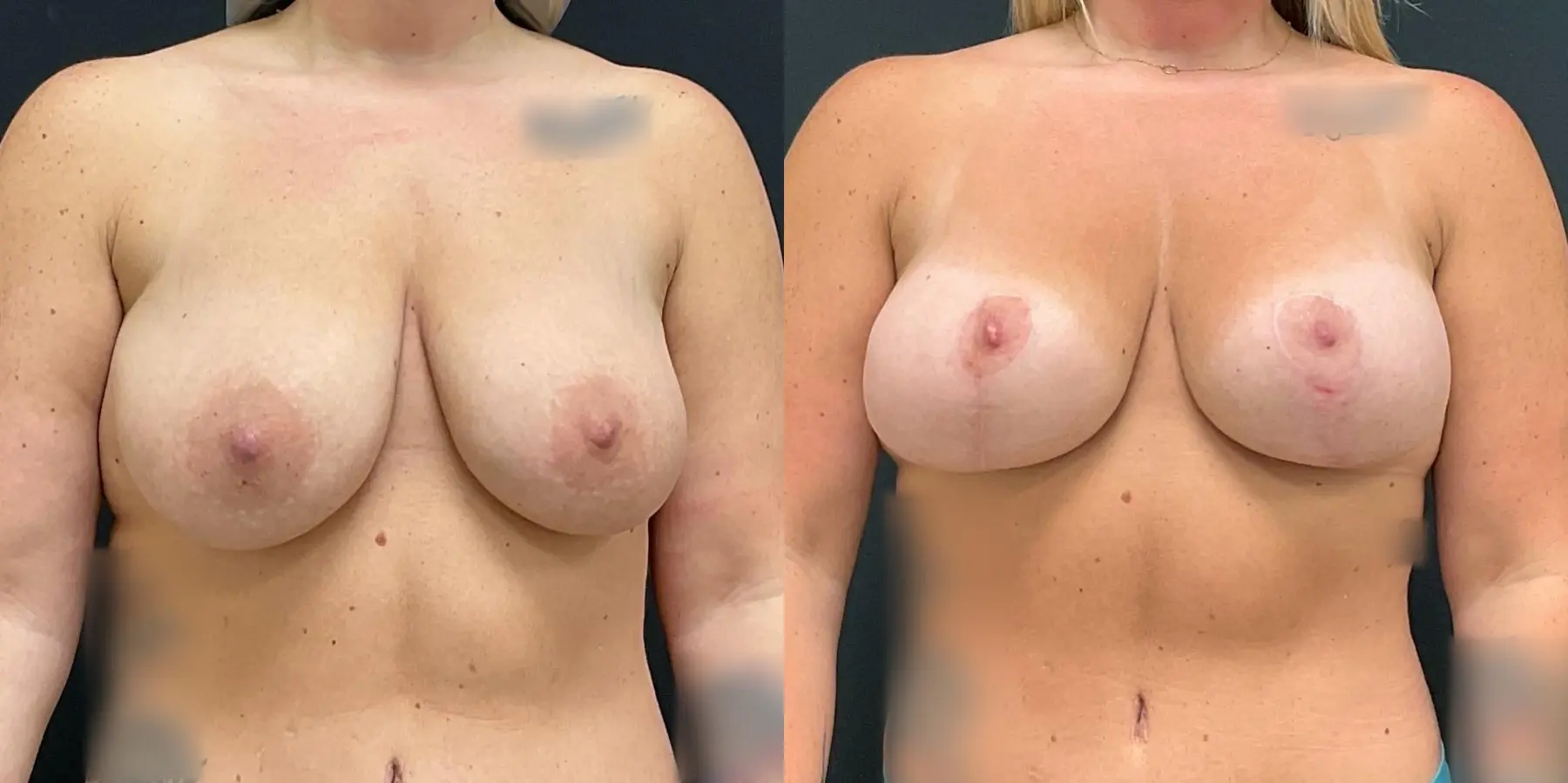 Breast Augmentation: Patient 11 - Before and After 1