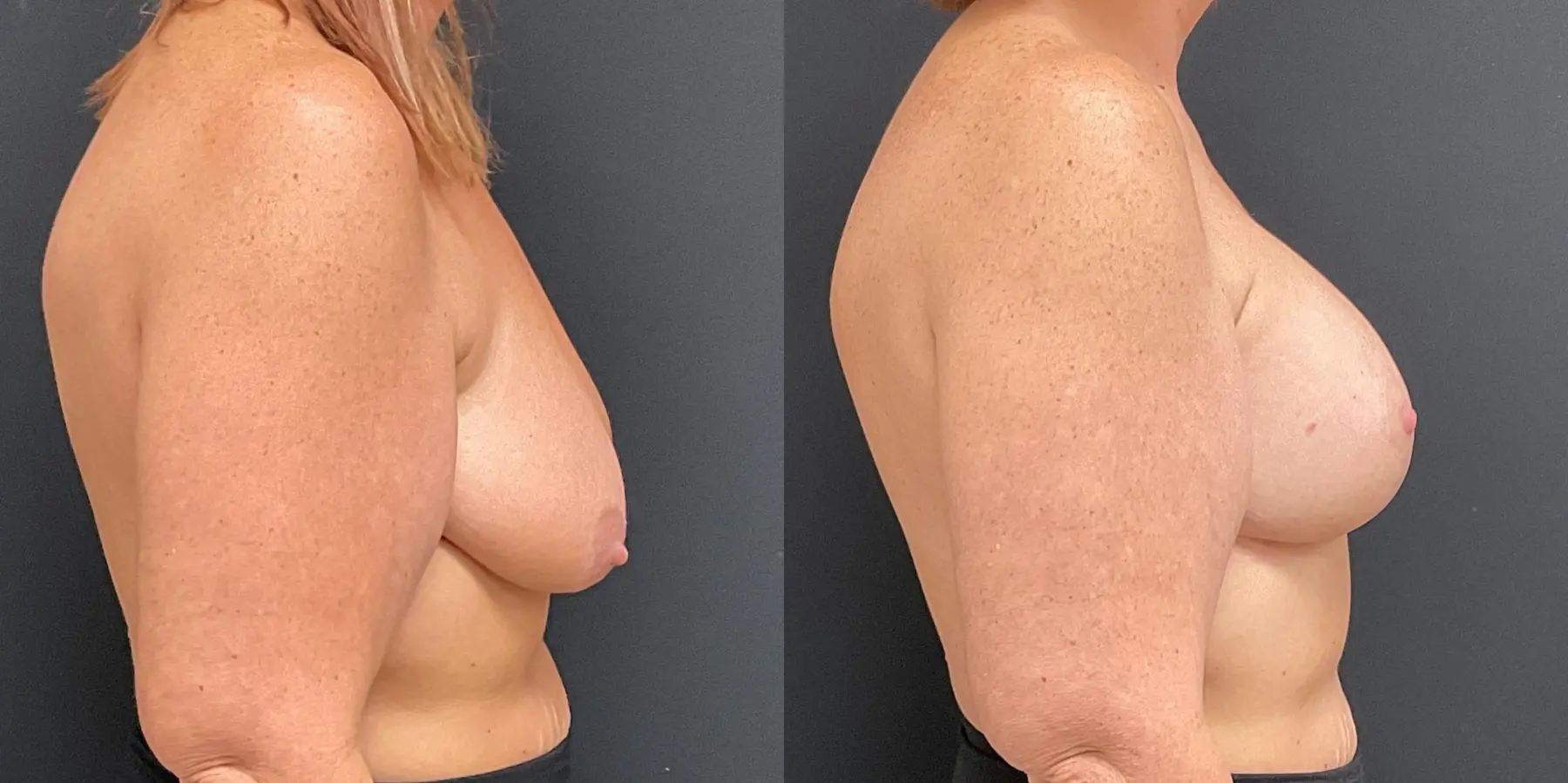 Breast Augmentation: Patient 11 - Before and After 5