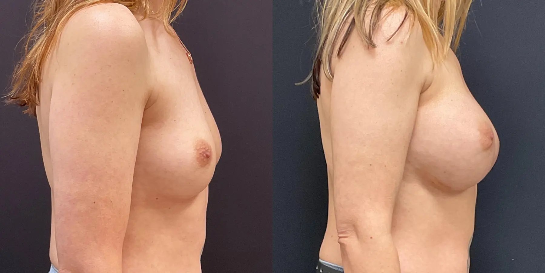 Breast Augmentation: Patient 3 - Before and After 5