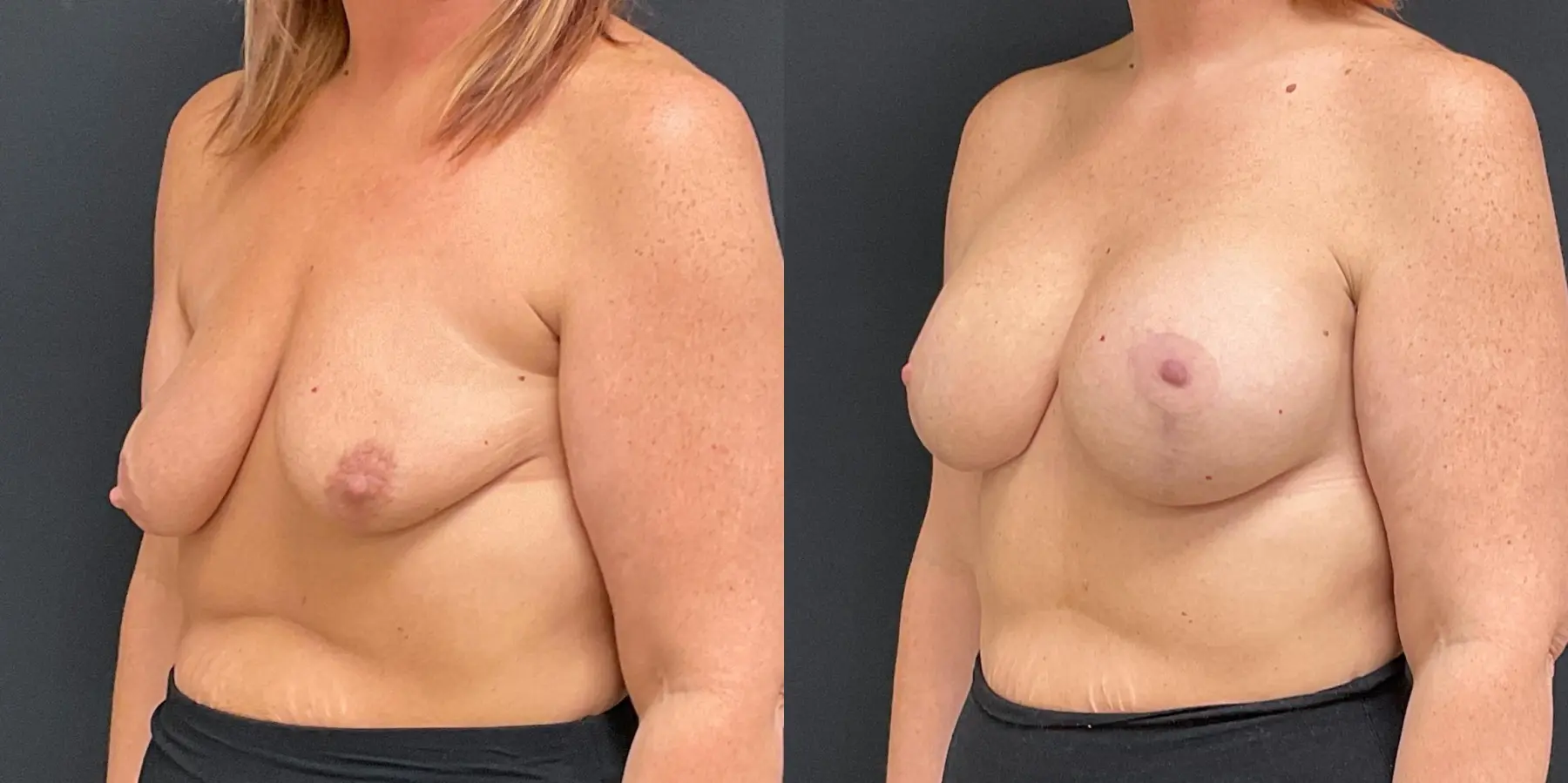 Breast Augmentation: Patient 11 - Before and After 2