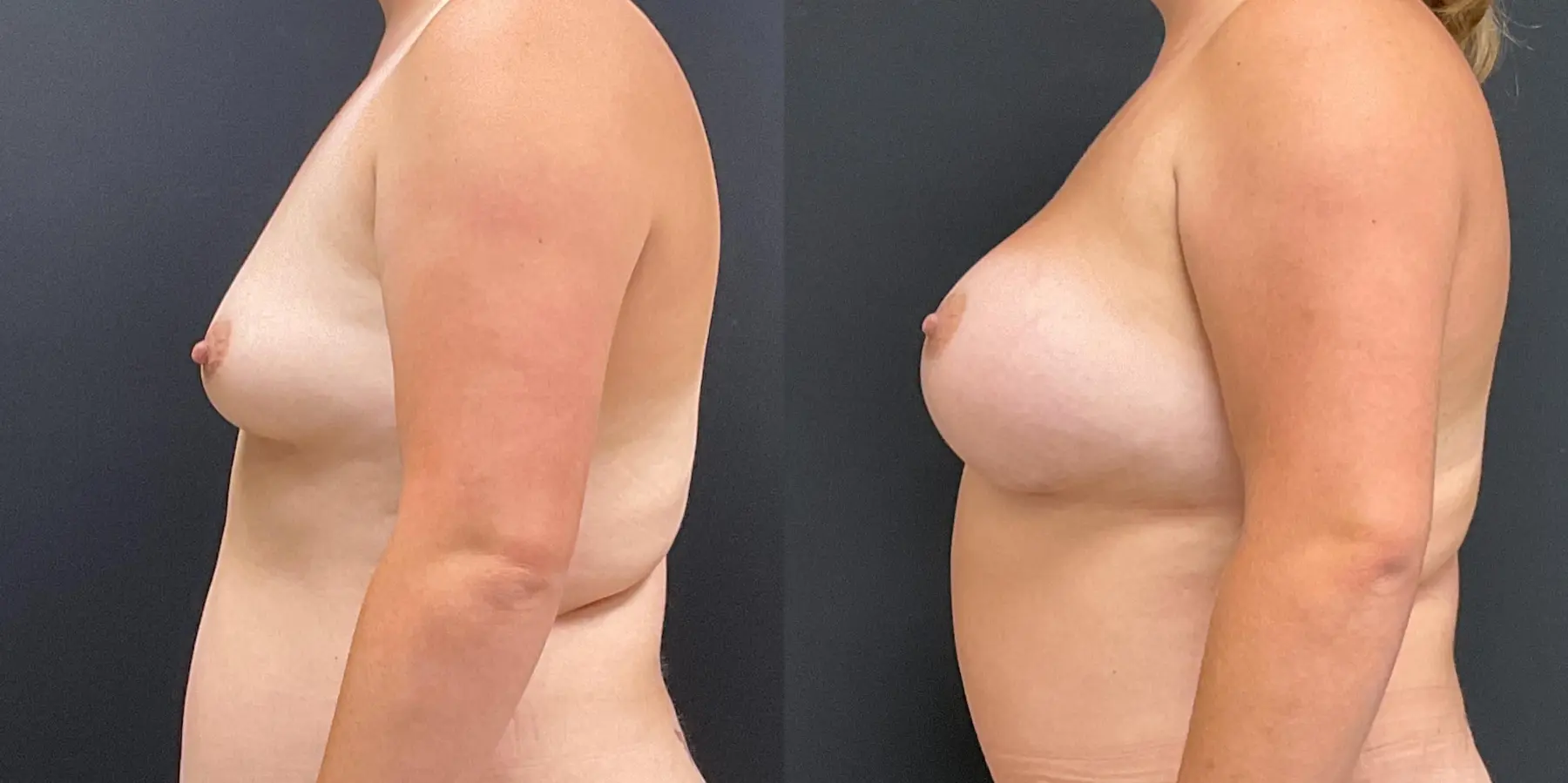 Breast Augmentation: Patient 4 - Before and After 4