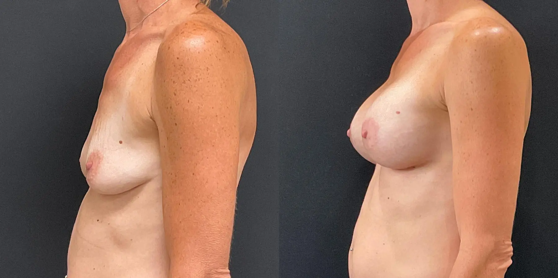 Breast Augmentation: Patient 5 - Before and After 4