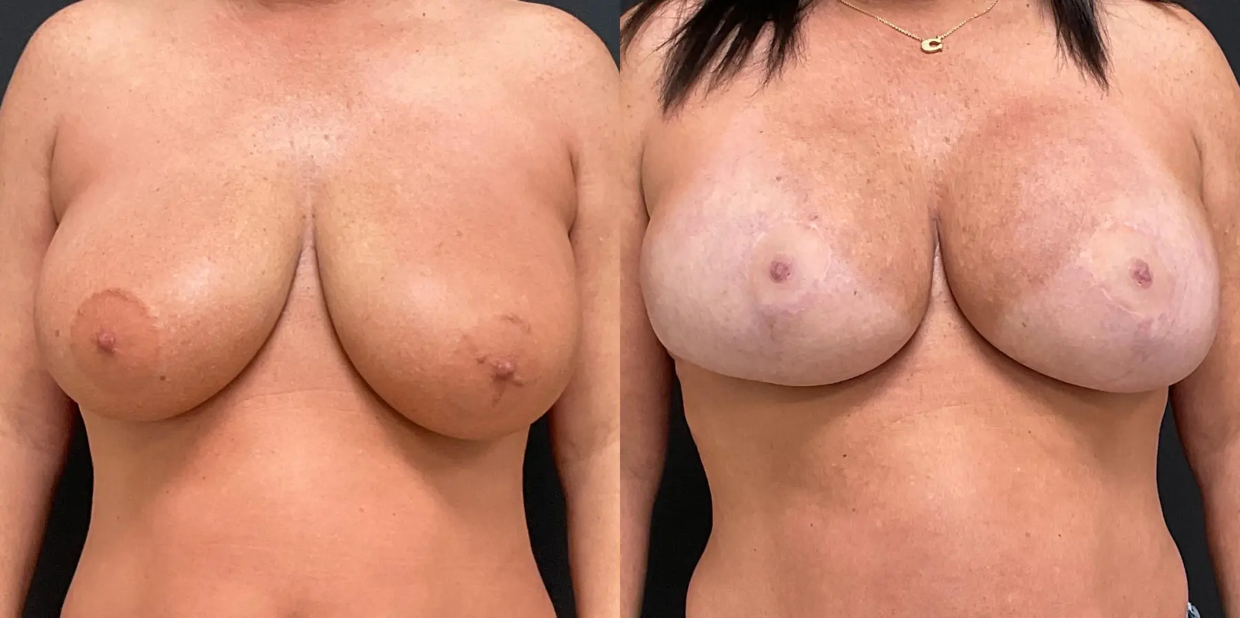 Breast Augmentation: Patient 6 - Before and After  