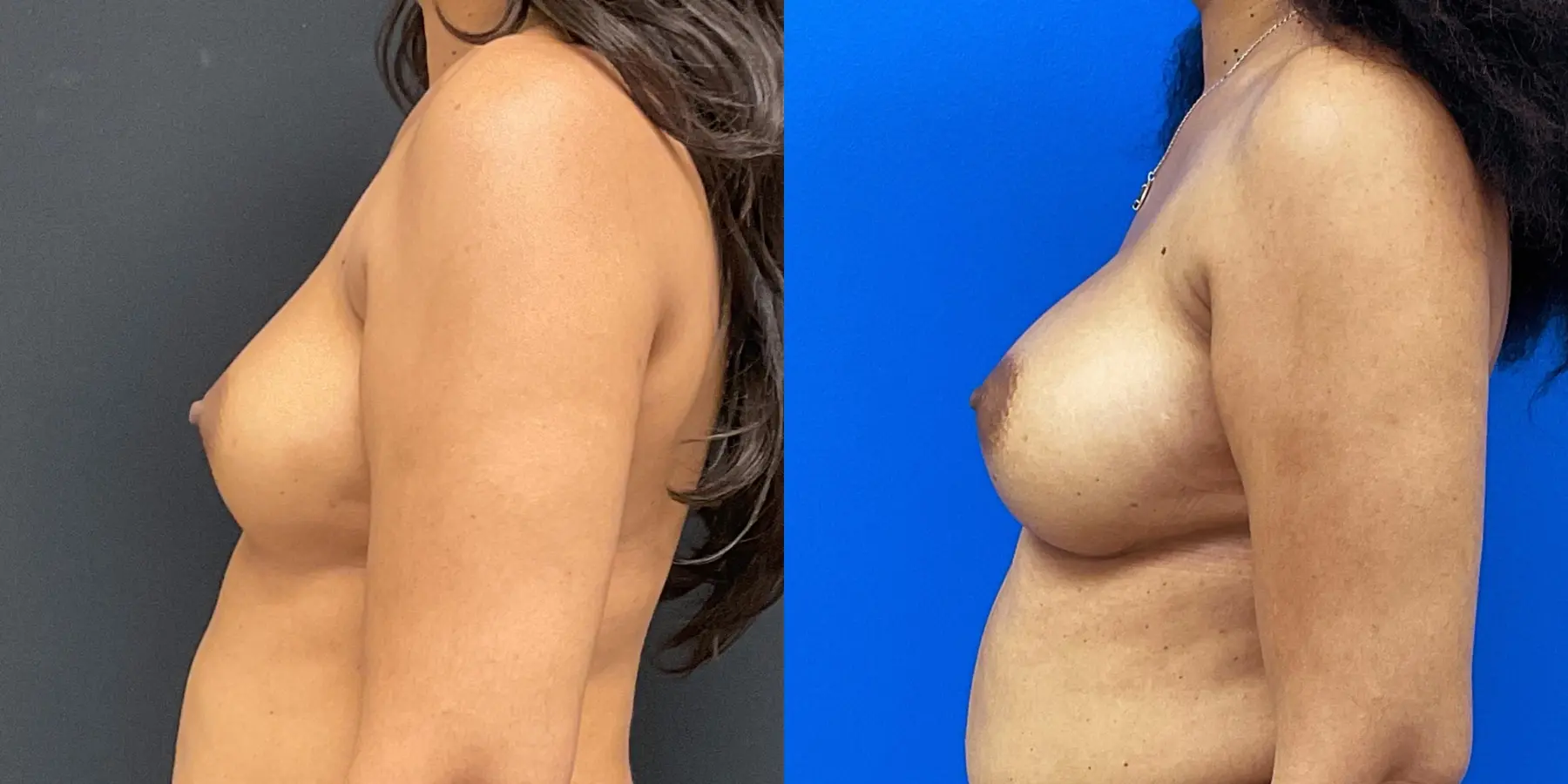 Breast Augmentation: Patient 1 - Before and After 4