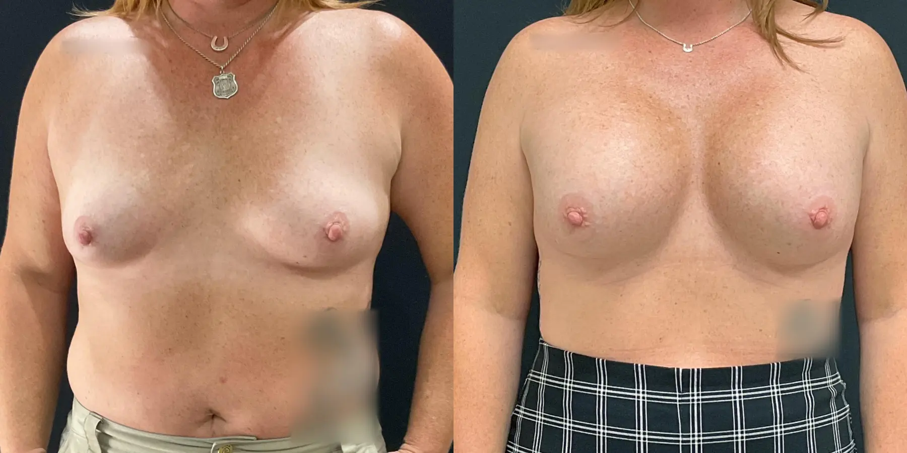 Breast Augmentation: Patient 6 - Before and After  