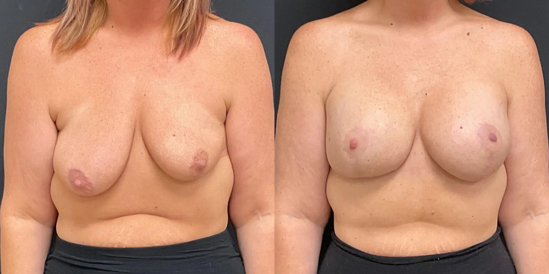 Breast Augmentation: Patient 11 - Before and After 1