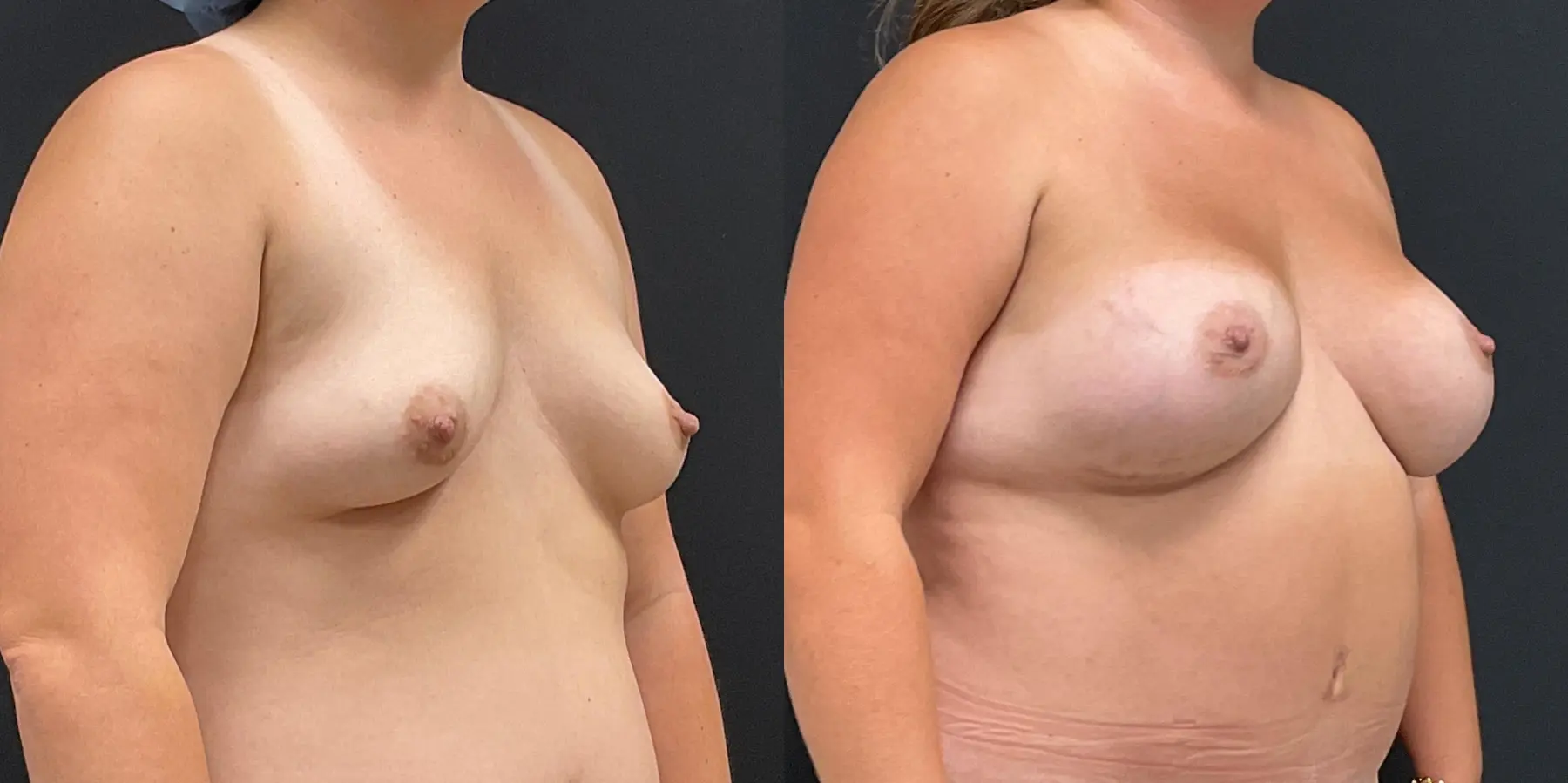 Breast Augmentation: Patient 2 - Before and After 3