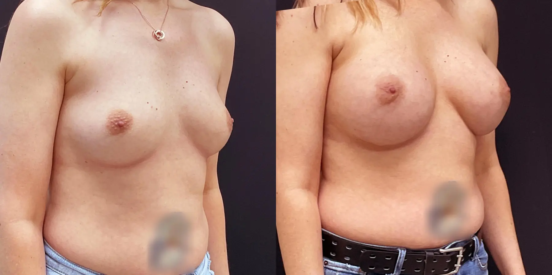 Breast Augmentation: Patient 3 - Before and After 3